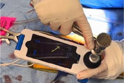 guiding an operation using bolt nav equipment.